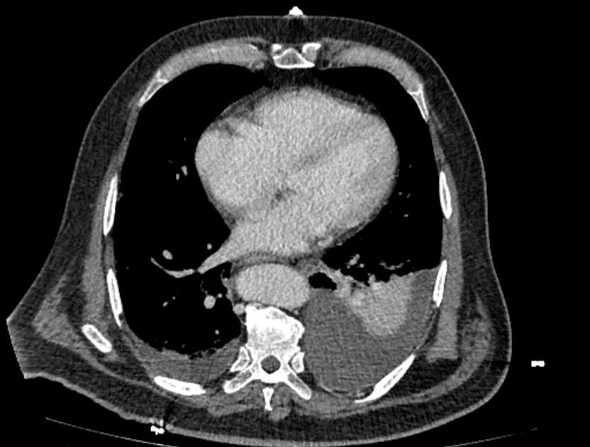 Abdominal aortic aneurysm rupture (Radiopaedia 54179-60362 Axial C+ portal venous phase 39).jpg