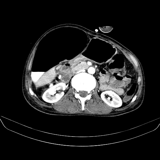 File:Abdominal collection due to previous cecal perforation (Radiopaedia 80831-94320 Axial C+ portal venous phase 85).jpg