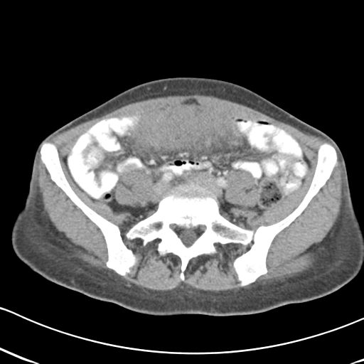 Abdominal desmoid tumor (Radiopaedia 41007-43740 Axial C+ portal venous phase 48).png