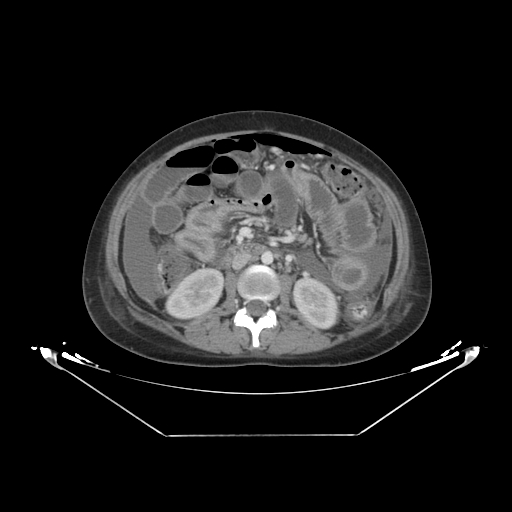 Abdominal gossypiboma- surgical towel (Radiopaedia 57288-64226 Axial C+ portal venous phase 30).jpg