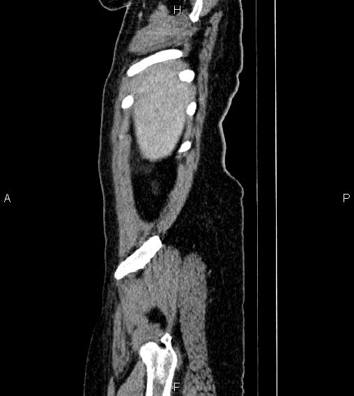 Abdominal lymphoma with sandwich sign (Radiopaedia 84378-99704 Sagittal C+ portal venous phase 89).jpg