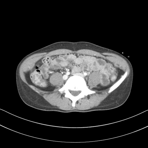 File:Abdominal multi-trauma - devascularised kidney and liver, spleen and pancreatic lacerations (Radiopaedia 34984-36486 Axial C+ portal venous phase 54).png