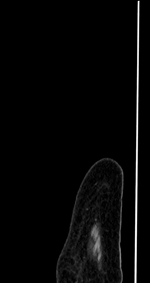 Abdominal wall and retroperitoneal tuberculosis (Radiopaedia 88137-104729 Sagittal C+ portal venous phase 3).jpg