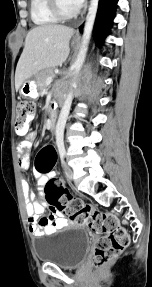 Abdominal wall and retroperitoneal tuberculosis (Radiopaedia 88137-104729 Sagittal C+ portal venous phase 68).jpg