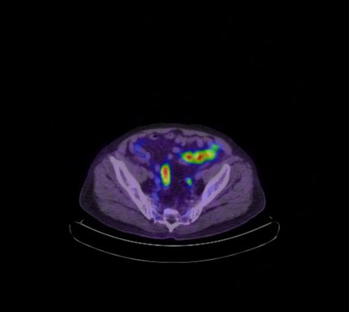 Abdominal wall metastasis from colorectal carcinoma (Radiopaedia 31016-31719 Axial 36).jpg