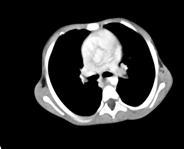 Abdominopelvic rhabdomyosarcoma (Radiopaedia 78356-90984 Axial C+ portal venous phase 18).jpg