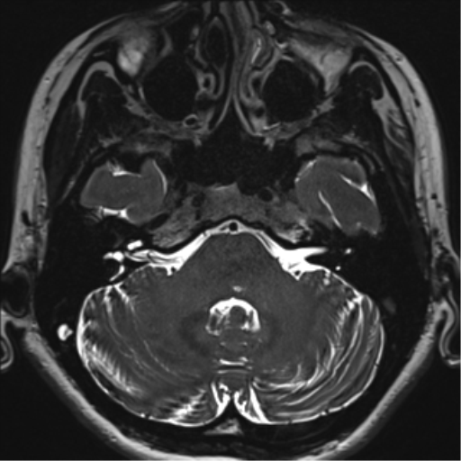 Abducens nerve palsy (Radiopaedia 51069-56648 Axial T2 fat sat 23).png
