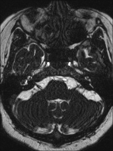 Abducens nerve palsy (Radiopaedia 57084-63976 Axial T2 ciss 3d 21).jpg