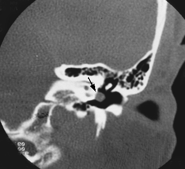 File:Aberrant internal carotid artery (Radiopaedia 22266-22303 Coronal bone window 1).jpg