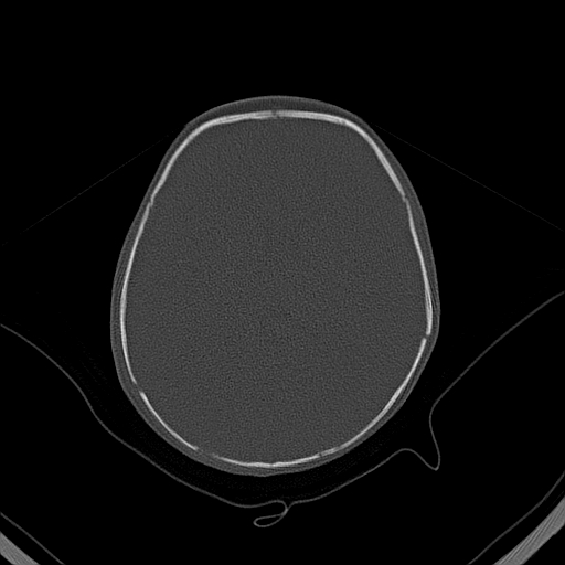 File:Accessory intraparietal suture (Radiopaedia 50584-56020 Axial bone window 25).jpg