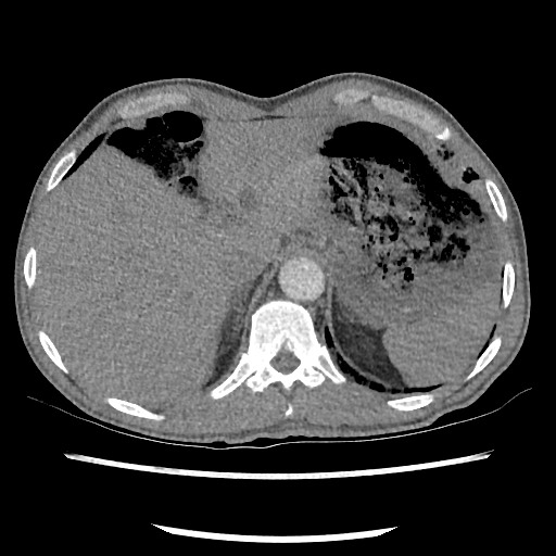 Accessory left horizontal fissure with lingular pneumonia (Radiopaedia 53763-59843 Axial C+ CTPA 84).jpg