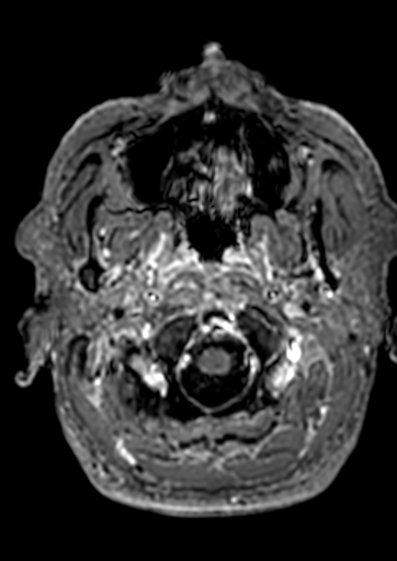 Accessory middle cerebral artery (Radiopaedia 73114-83828 Axial T1 C+ 192).jpg