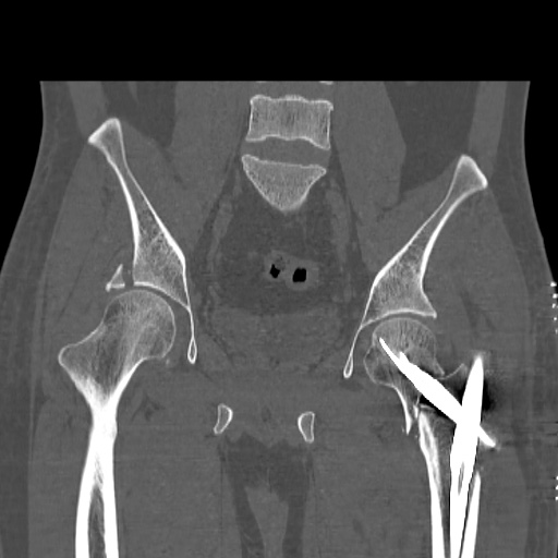 Acetabular and ilial fractures (Radiopaedia 59084-66378 Coronal bone window 28).jpg