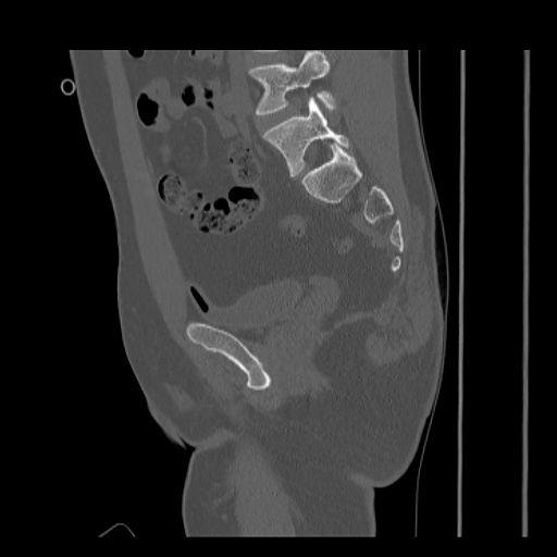 Acetabular and ilial fractures (Radiopaedia 59084-66378 Sagittal bone window 45).jpg