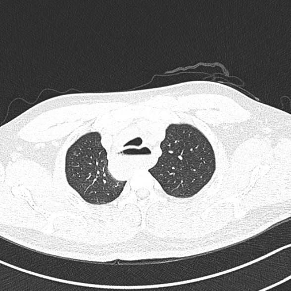 Achalasia with aspiration (Radiopaedia 55413-61845 Axial lung window 11).jpg