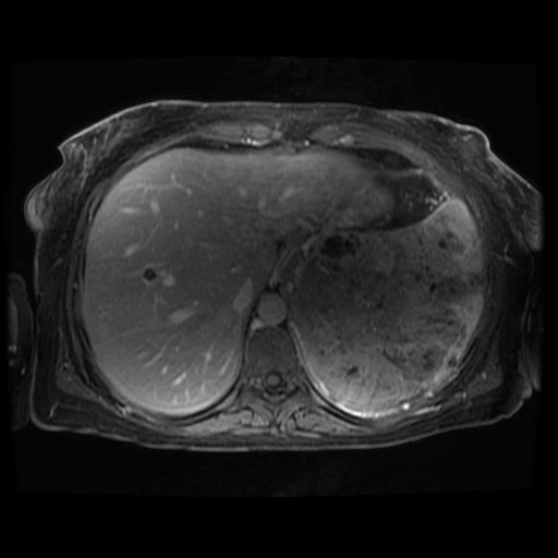 Acinar cell carcinoma of the pancreas (Radiopaedia 75442-86668 Axial T1 C+ fat sat 111).jpg