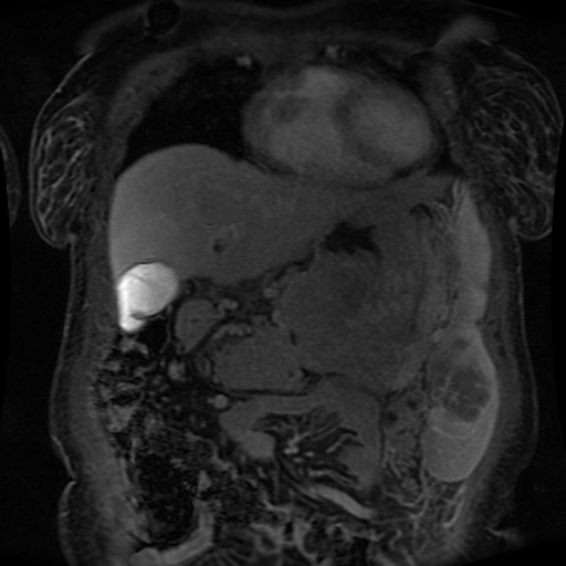 Acinar cell carcinoma of the pancreas (Radiopaedia 75442-86668 Coronal T1 C+ fat sat 139).jpg