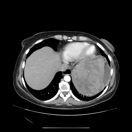 Acinar cell carcinoma of the pancreas (Radiopaedia 75442-86669 Axial C+ portal venous phase 12).jpg