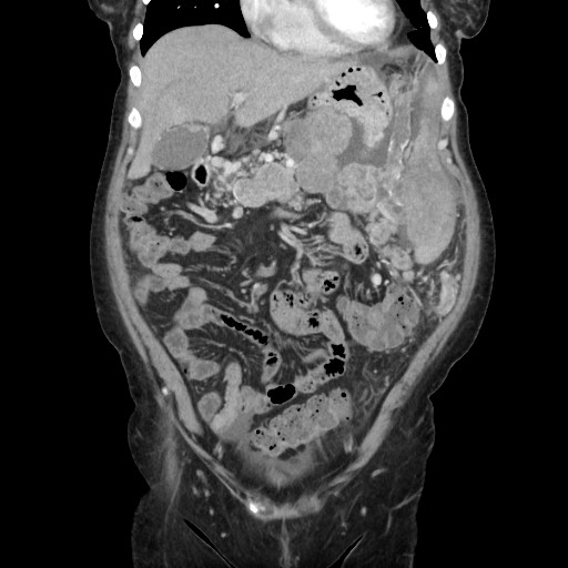 Acinar cell carcinoma of the pancreas (Radiopaedia 75442-86669 Coronal C+ portal venous phase 40).jpg