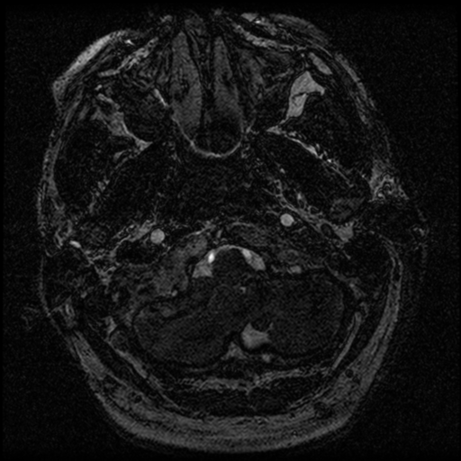 File:Acoustic schwannoma (Radiopaedia 39170-41387 Axial FIESTA 12).png