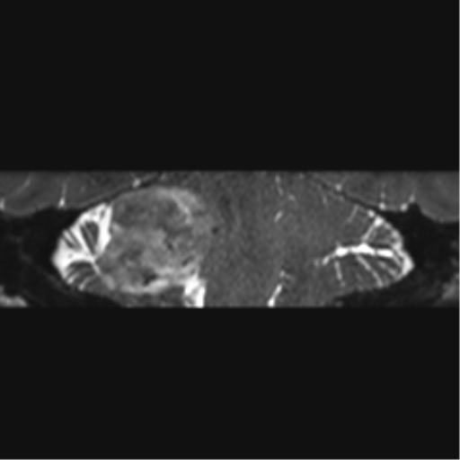 File:Acoustic schwannoma (Radiopaedia 50846-56358 Coronal T2 17).png