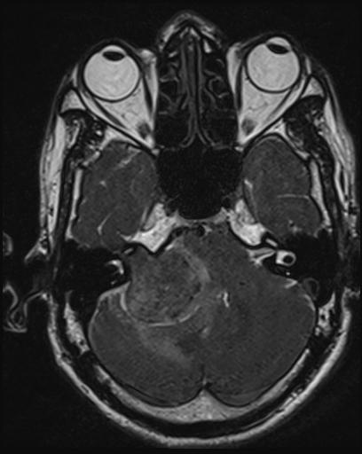 Acoustic schwannoma - probable (Radiopaedia 20386-20292 Axial T1 39).jpg