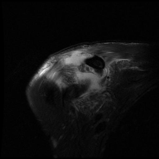 File:Acromioclavicular joint dislocation (Radiopaedia 14218-14076 Coronal PD fat sat 5).jpg