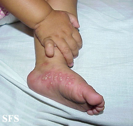 Acropustulosis Infantile (Dermatology Atlas 1).jpg