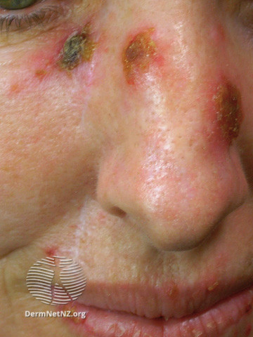 File:Actinic Keratoses treated with imiquimod (DermNet NZ lesions-ak-imiquimod-3760).jpg