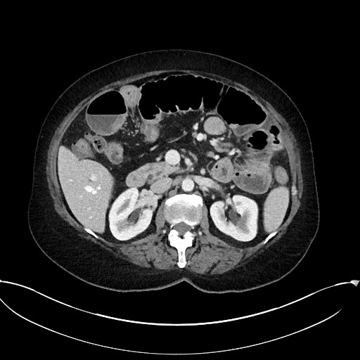 File:Active Crohn disease (Radiopaedia 59394-66750 Axial C+ portal venous phase 28).jpg