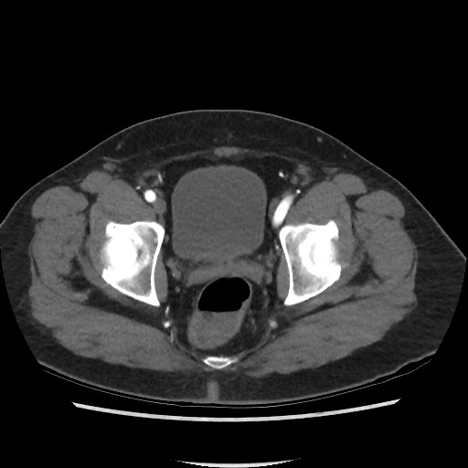 File:Active colonic bleed on CT (Radiopaedia 49765-55025 Axial C+ arterial phase 76).jpg