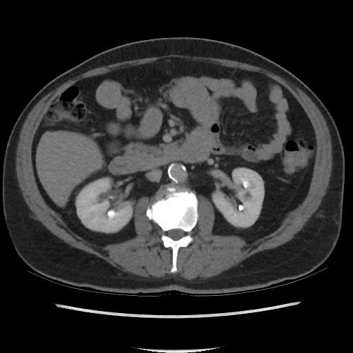 File:Active colonic bleed on CT (Radiopaedia 49765-55025 Axial C+ delayed 35).jpg