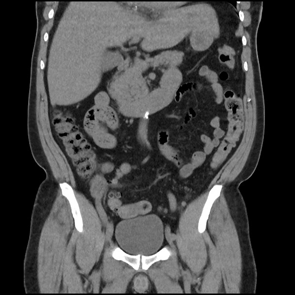 Active colonic bleed on CT (Radiopaedia 49765-55025 Coronal non-contrast 25).jpg