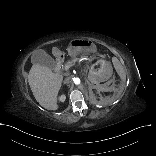 Active renal extravasation with large subcapsular and retroperitoneal hemorrhage (Radiopaedia 60975-68796 Axial C+ arterial phase 67).jpg