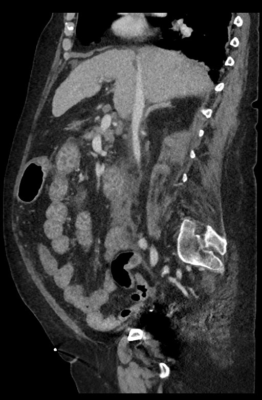 Active renal extravasation with large subcapsular and retroperitoneal hemorrhage (Radiopaedia 60975-68796 Sagittal C+ portal venous phase 135).jpg