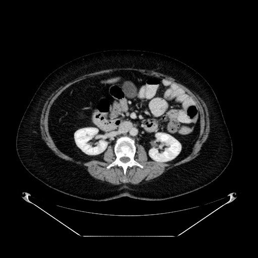 Acute appendicitis, heterotaxy syndrome (Radiopaedia 66884-76202 Axial C+ portal venous phase 55).jpg
