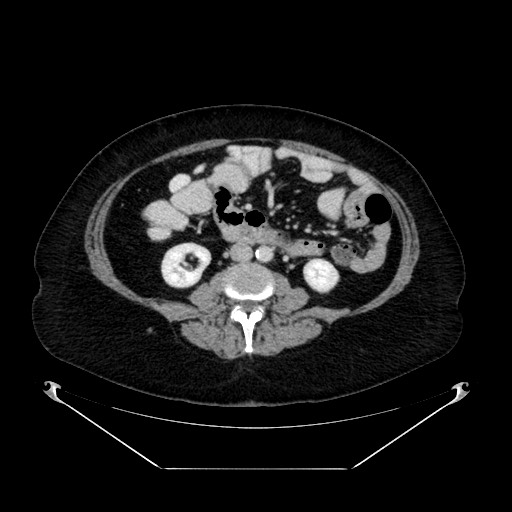 File:Acute appendicitis, heterotaxy syndrome (Radiopaedia 66884-76202 Axial C+ portal venous phase 68).jpg