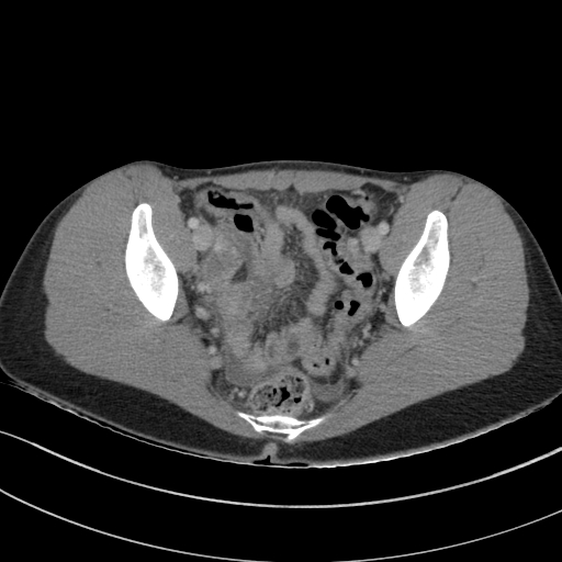 Acute appendicitis (Radiopaedia 62608-70901 Axial C+ portal venous phase 39).jpg