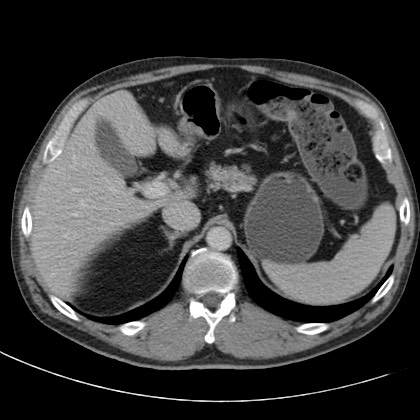 File:Acute appendicitis (Radiopaedia 66513-75790 Axial C+ portal venous phase 10).jpg