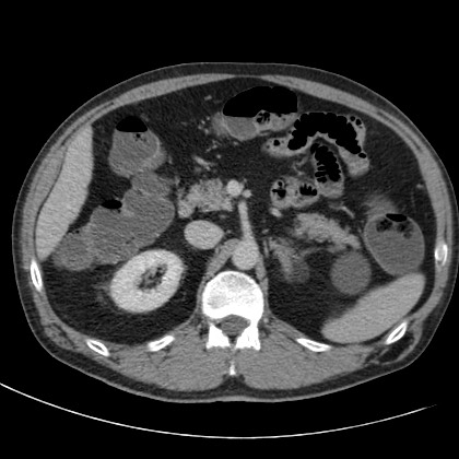 Acute appendicitis (Radiopaedia 66513-75790 Axial C+ portal venous phase 19).jpg