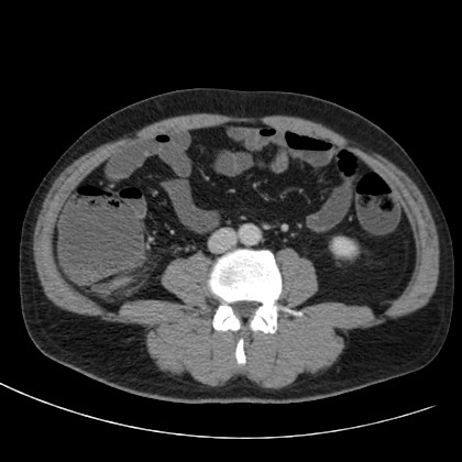 Acute appendicitis (Radiopaedia 66513-75790 Axial C+ portal venous phase 47).jpg