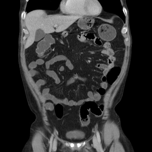 Acute appendicitis (Radiopaedia 66513-75790 Coronal C+ portal venous phase 15).jpg
