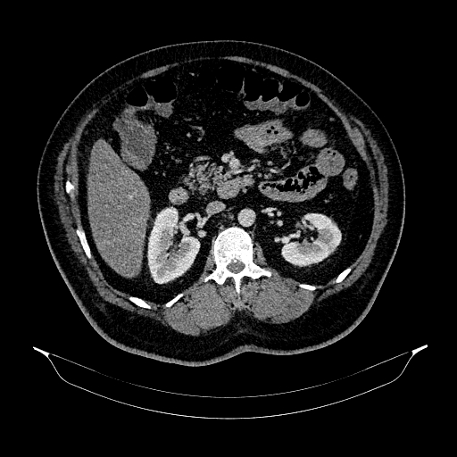 Acute appendicitis (Radiopaedia 79950-93224 Axial C+ portal venous phase 43).jpg