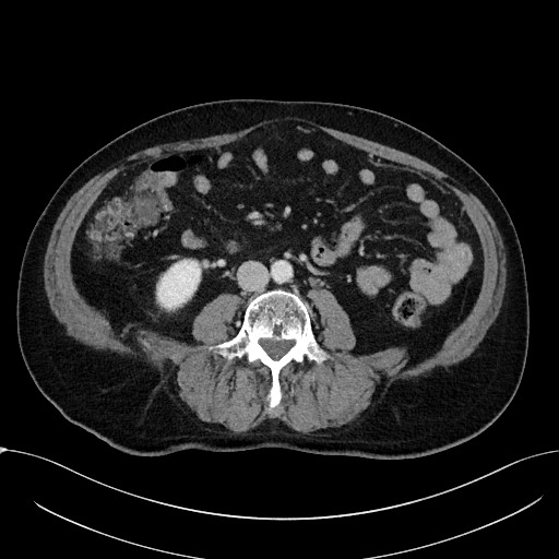 Acute appendicitis - large appendicoliths (Radiopaedia 61805-69820 Axial C+ portal venous phase 71).jpg