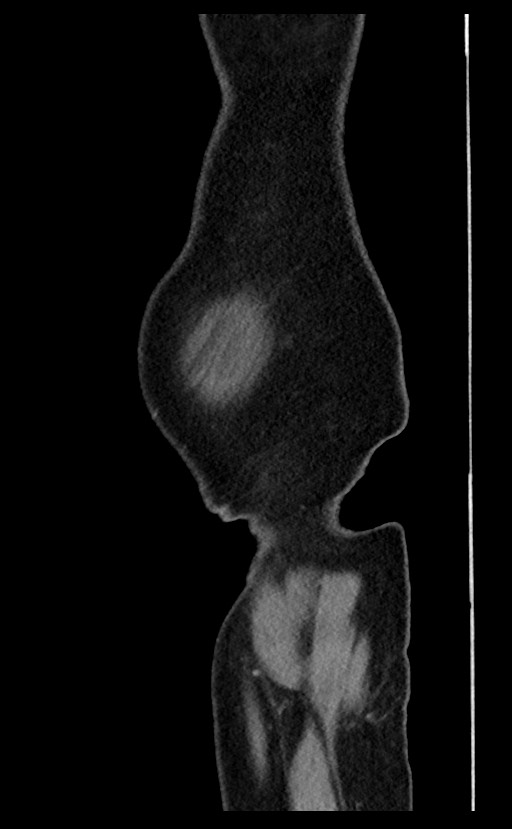 Acute appendicitis - large appendicoliths (Radiopaedia 61805-69820 Sagittal C+ portal venous phase 1).jpg