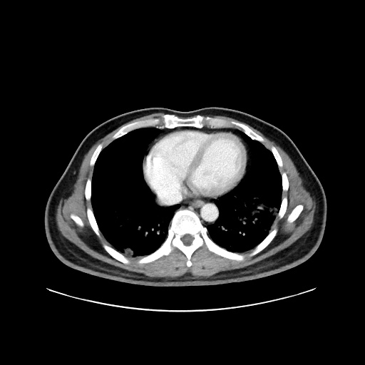 File:Acute appendicitis and COVID 19 pneumonia (Radiopaedia 76604-88380 Axial C+ portal venous phase 1).jpg