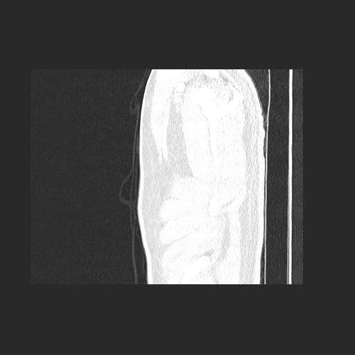 Acute appendicitis and COVID 19 pneumonia (Radiopaedia 76604-88380 Sagittal lung window 6).jpg