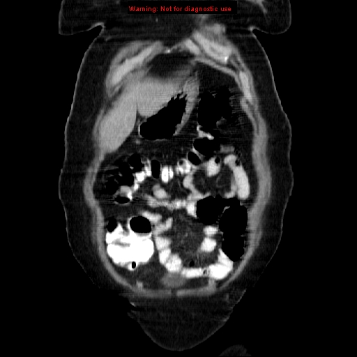 Acute appendicitis complicated by ovarian vein thrombophlebitis (Radiopaedia 16172-15851 Coronal C+ portal venous phase 18).jpg
