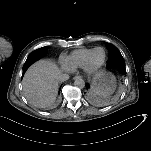 File:Acute aspiration pneumonitis (Radiopaedia 55642-62166 Axial liver window 50).jpg