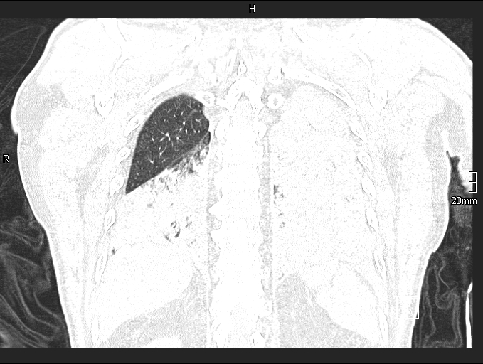Acute aspiration pneumonitis (Radiopaedia 55642-62166 Coronal lung window 83).jpg